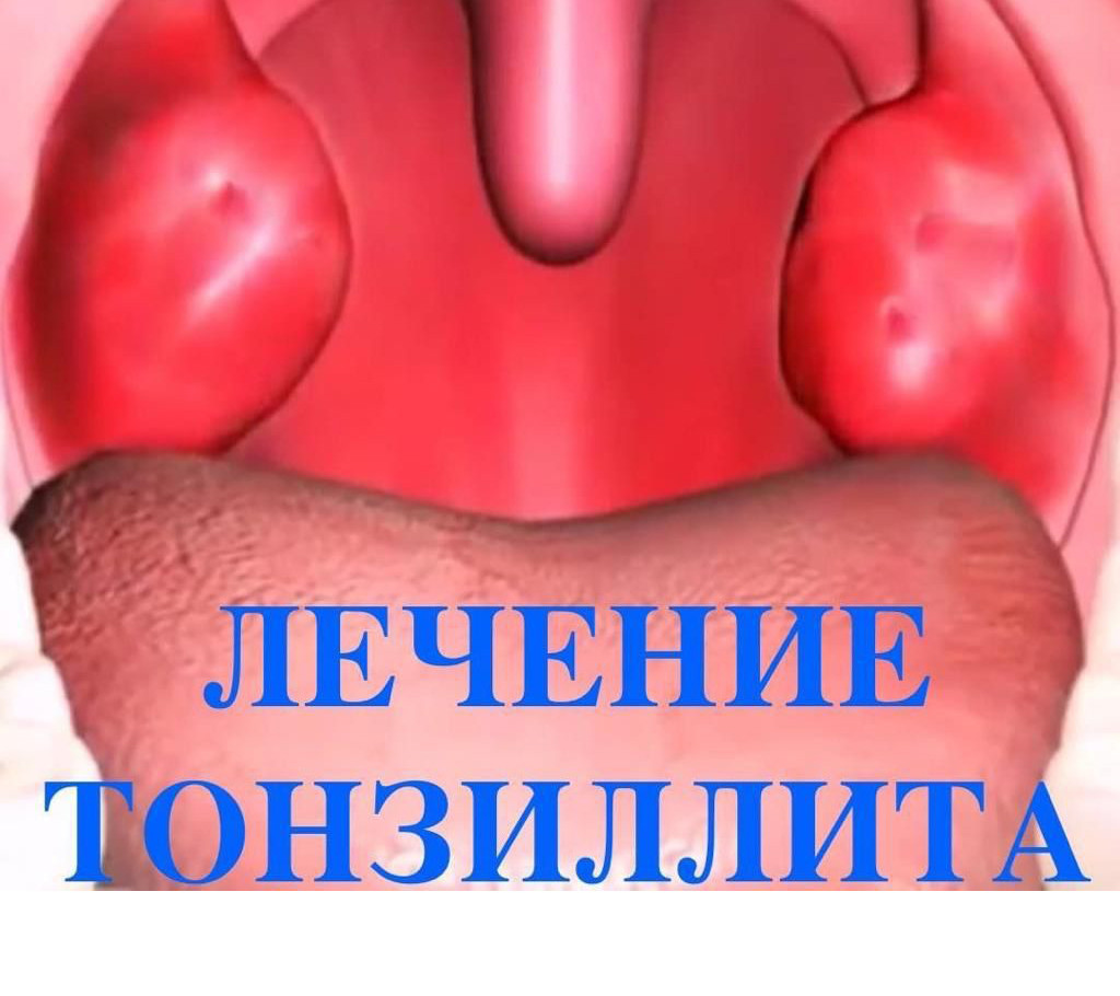 Лечение хронического тонзиллита Лечение хронического тонзиллита