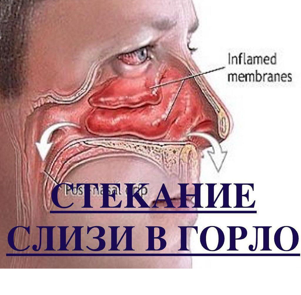 Причины слизи в горле Причины слизи в горле
